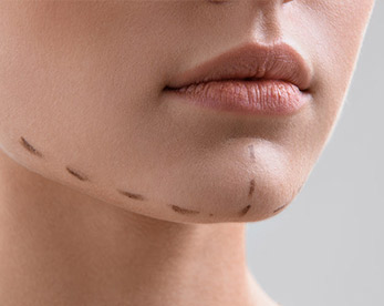 Implantes pomulos - Clínica Aguilar Rosell Torremolinos